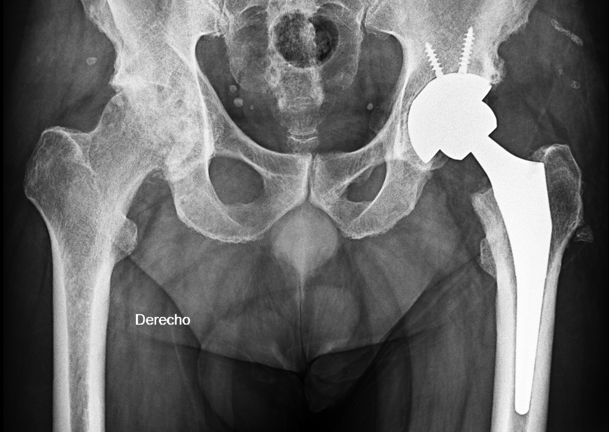 Hombre, 54 años. Artrosis de cadera izquierda. :: Drmauroandreoli-com-ar
